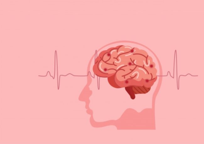 Stroke Post image what is stroke