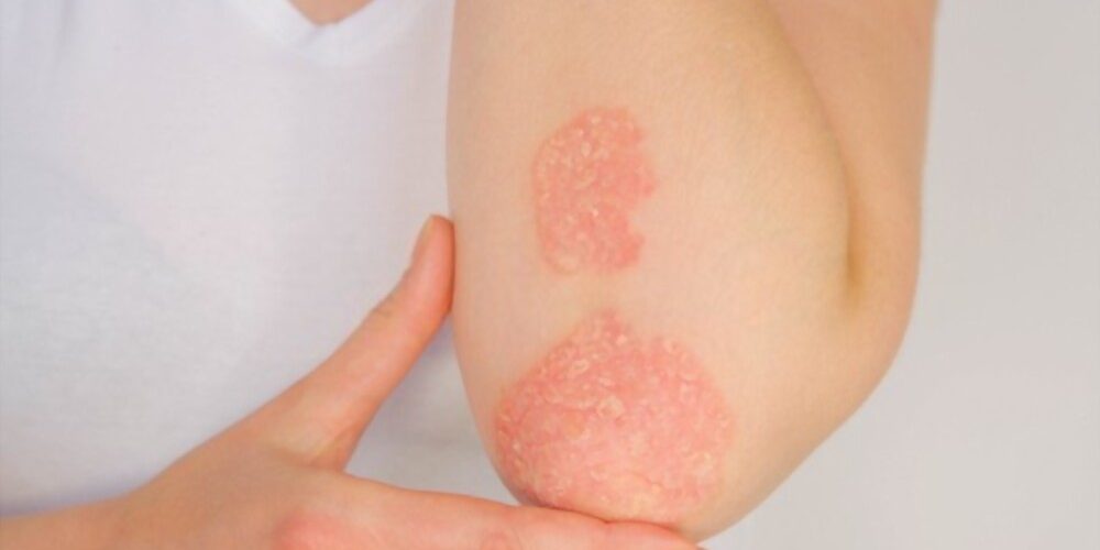 Psoriasis