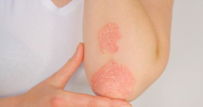Psoriasis Psoriasis